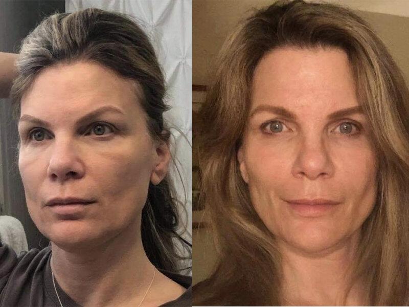 Elevate Your Glow: Discover the Ultimate Fotona Laser Treatment in Dubai