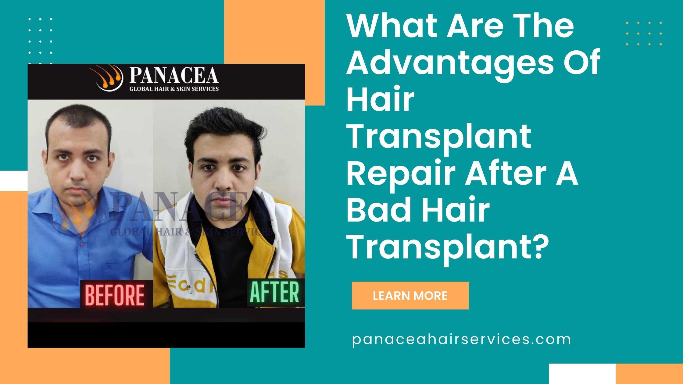 What Are The Advantages Of Hair Transplant Repair After A Bad Hair Transplant?
