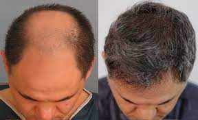 How to recover alopecia organically?